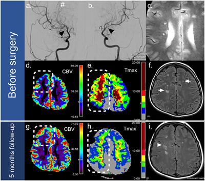 Case Report: Successful Cerebral Revascularization and Cardiac Transplant in a 16-Year-Old Male With Syndromic BRCC3-Related Moyamoya Angiopathy